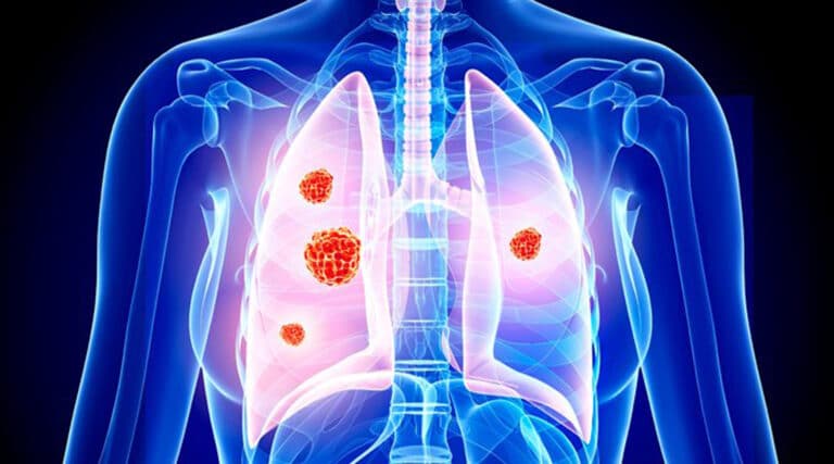 nsclc2