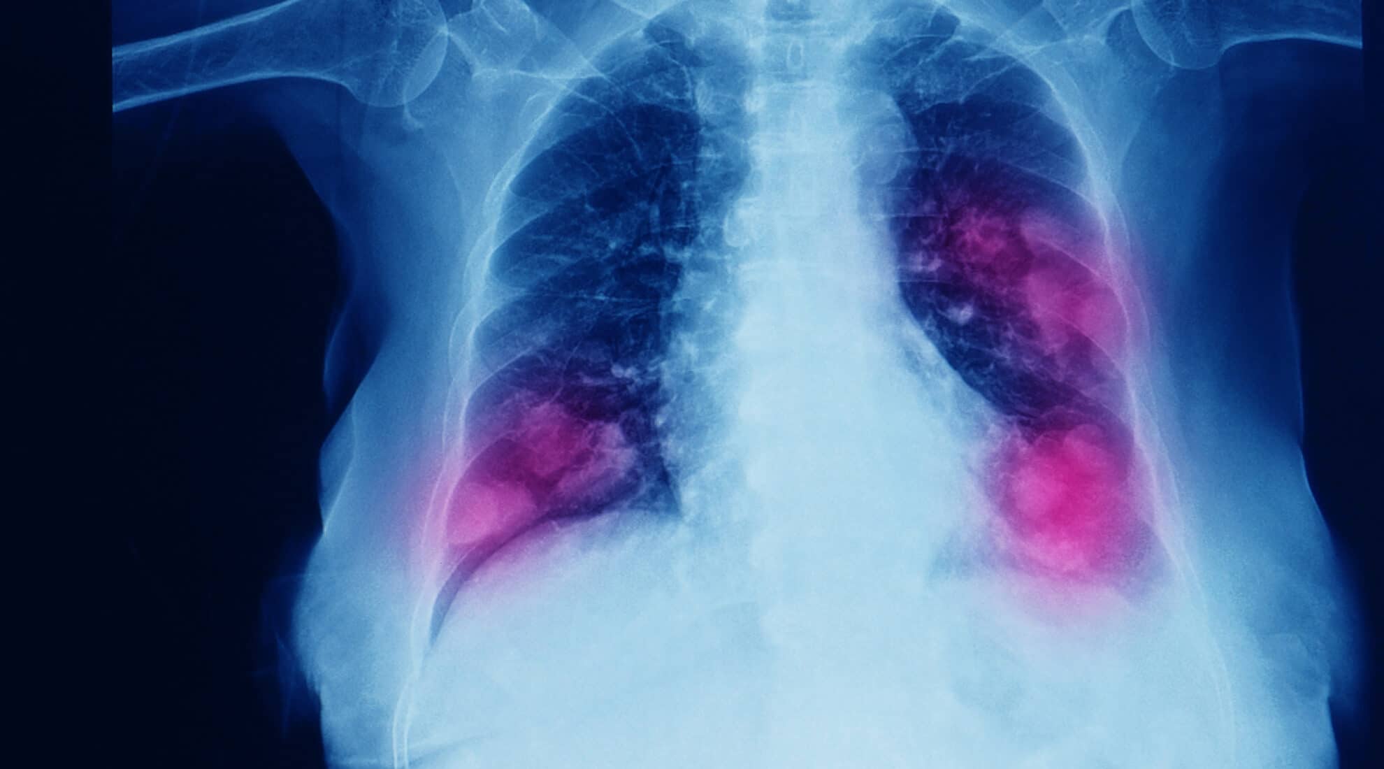 FDA Approves Exkivity for NSCLC Subset | Anton RX Report