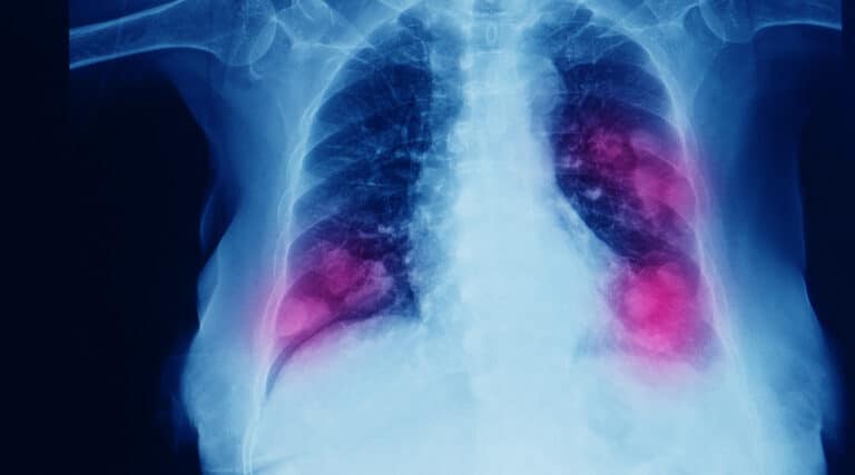 non small cell lung cancer