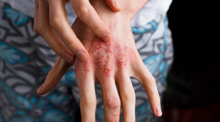 Atopic Dermatitis