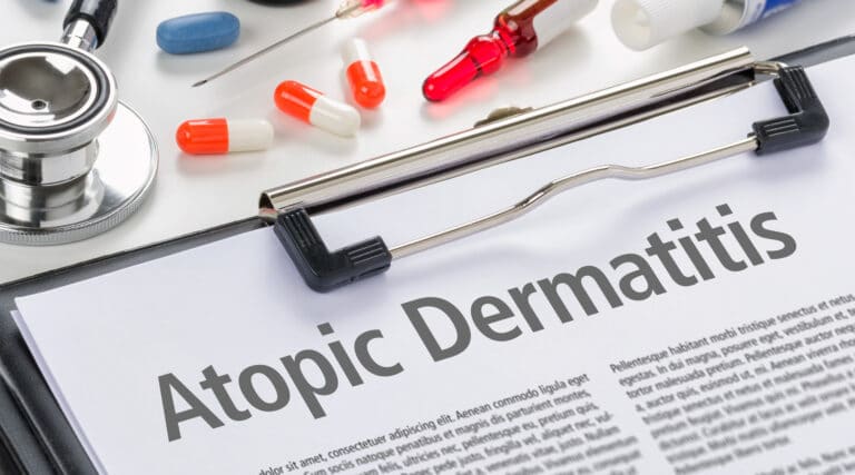 atopic dermatitis