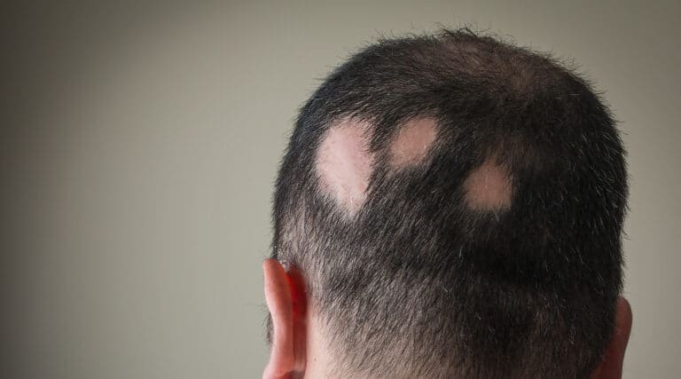 Alopecia